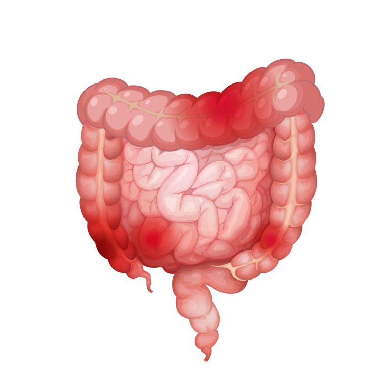 Colon irritable ¿de qué se trata?